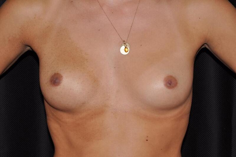 Breast Augmentation Before & After Image