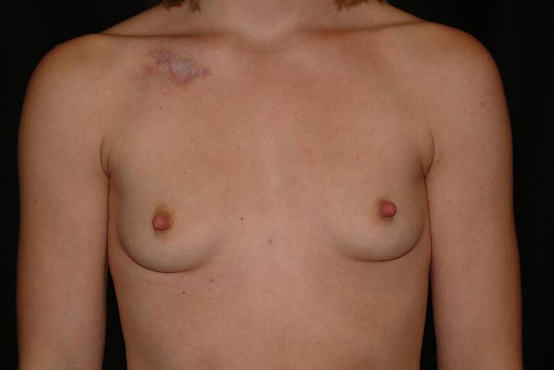 Breast Augmentation Before & After Image