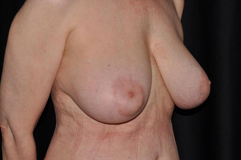 Breast Reduction Before & After Image