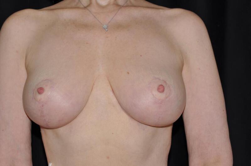 Breast Reduction Before & After Image