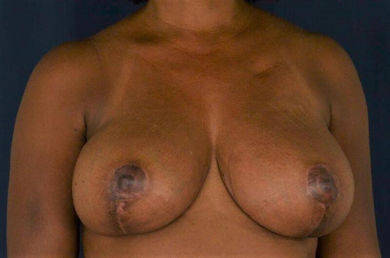 Breast Reduction Before & After Image