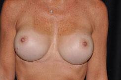 Breast Revision Before & After Image