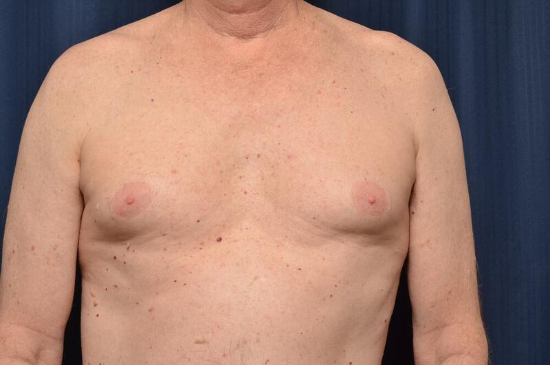 Gynecomastia Before & After Image