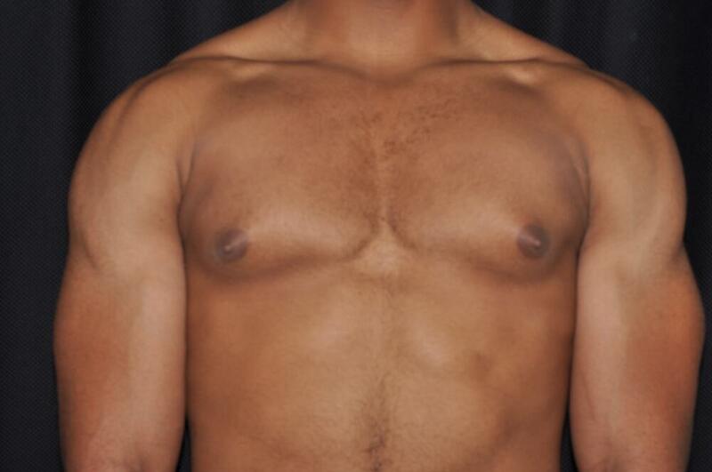 Gynecomastia Before & After Image