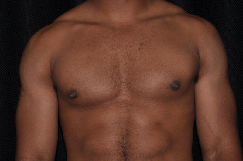 Gynecomastia Before & After Image