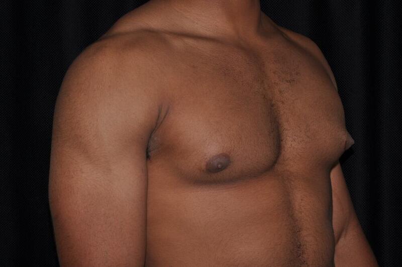 Gynecomastia Before & After Image