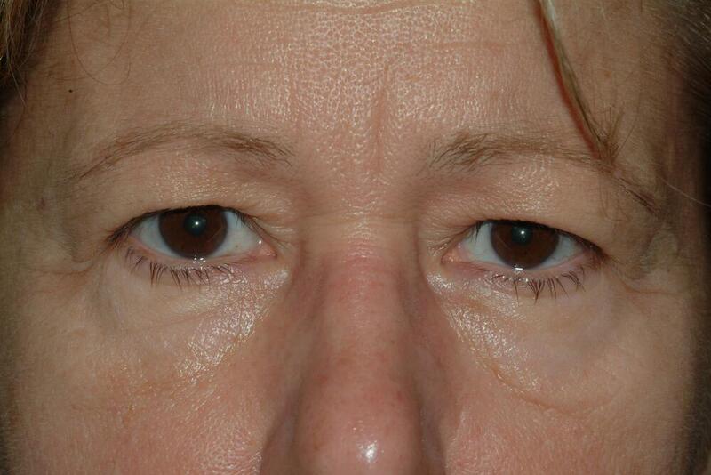 Blepharoplasty Before & After Image