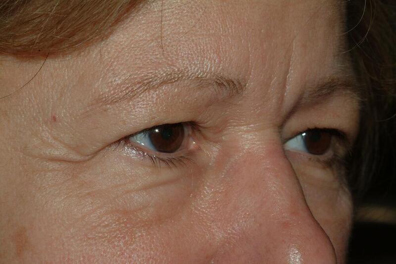 Blepharoplasty Before & After Image