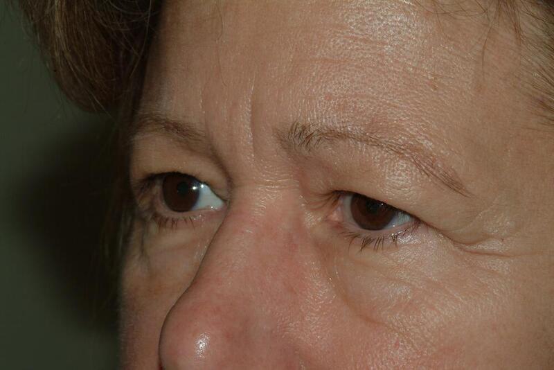 Blepharoplasty Before & After Image