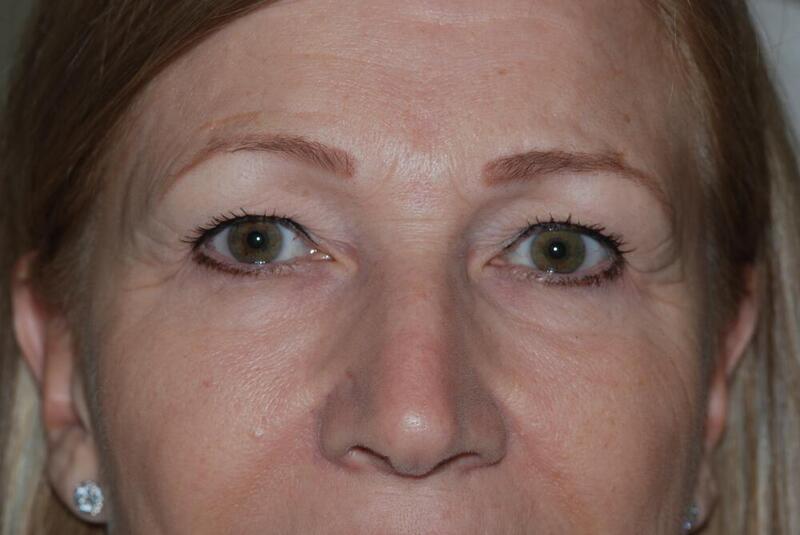 Blepharoplasty Before & After Image