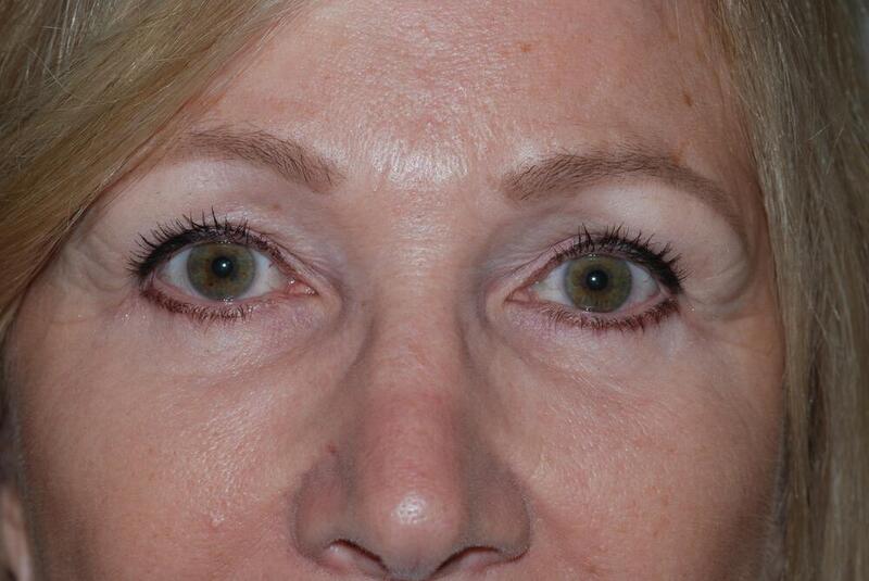 Blepharoplasty Before & After Image