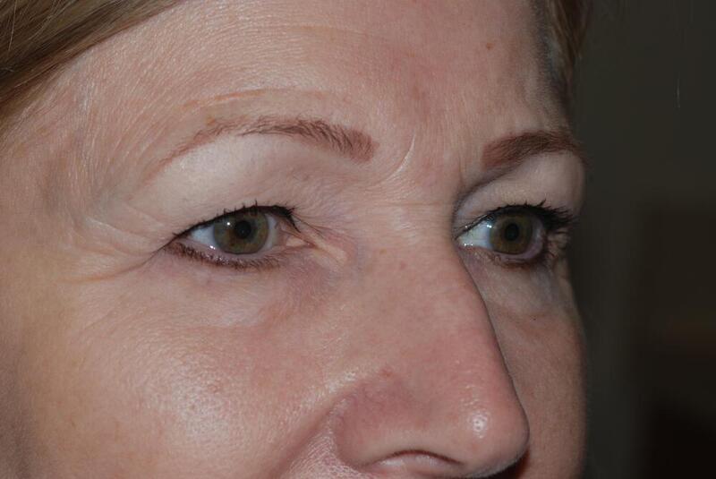 Blepharoplasty Before & After Image