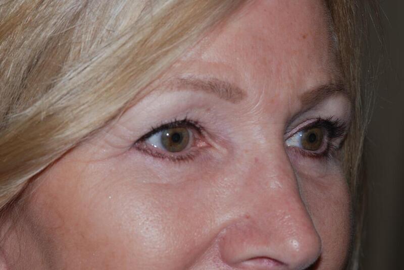 Blepharoplasty Before & After Image