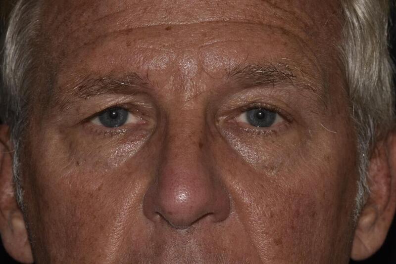 Blepharoplasty Before & After Image