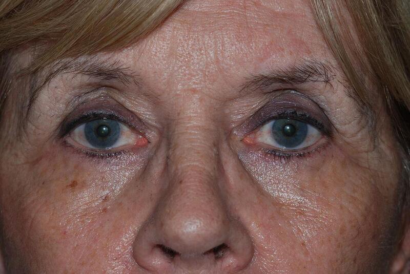 Blepharoplasty Before & After Image