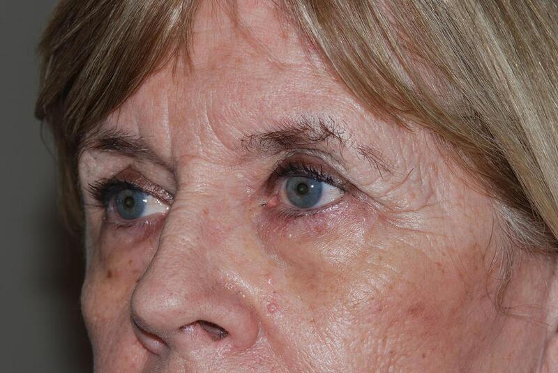 Blepharoplasty Before & After Image