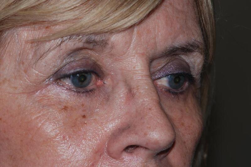 Blepharoplasty Before & After Image