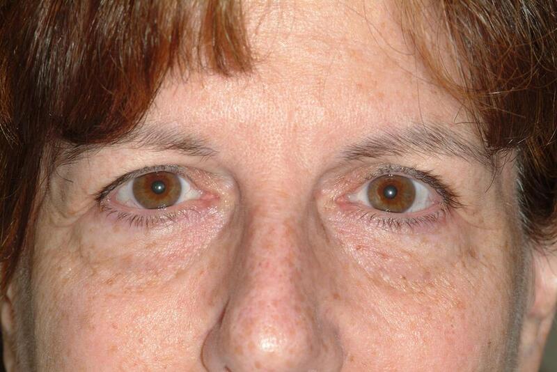 Blepharoplasty Before & After Image