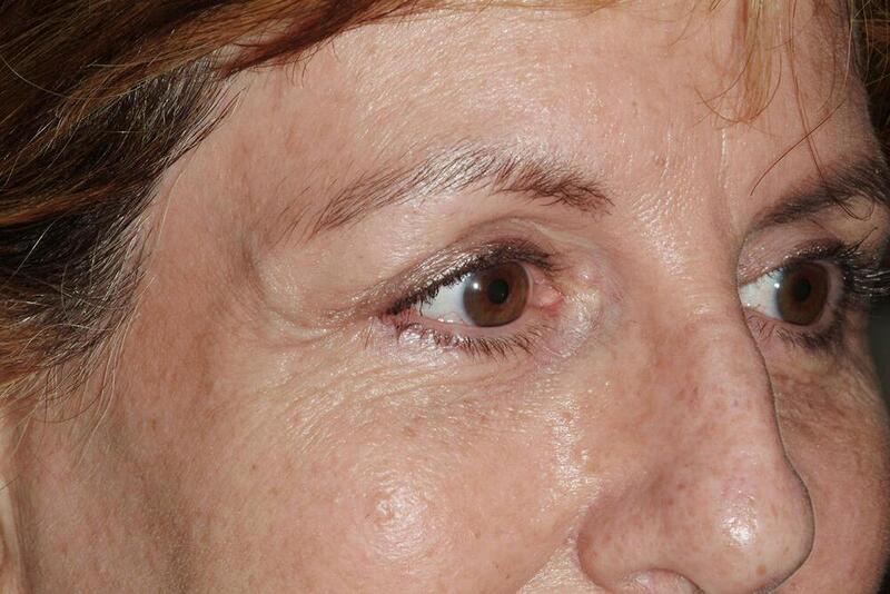 Blepharoplasty Before & After Image