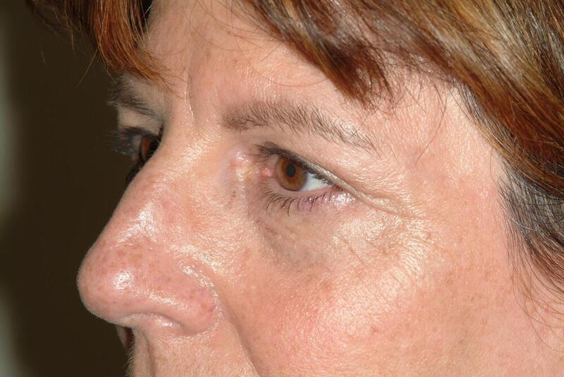 Blepharoplasty Before & After Image