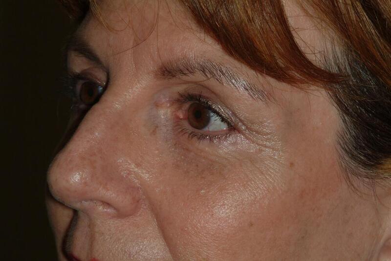 Blepharoplasty Before & After Image