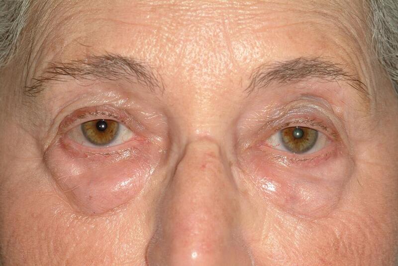 Blepharoplasty Before & After Image