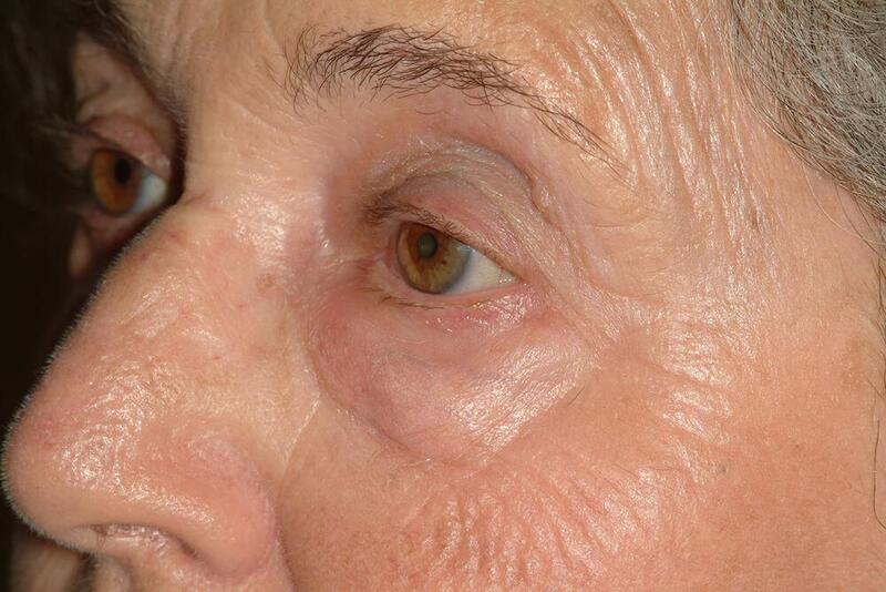 Blepharoplasty Before & After Image