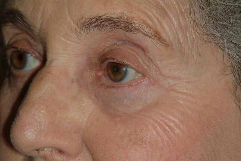 Blepharoplasty Before & After Image