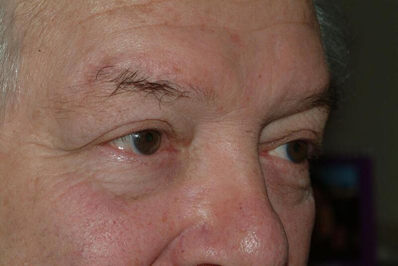 Blepharoplasty Before & After Image