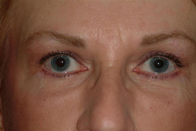 Blepharoplasty Before & After Image