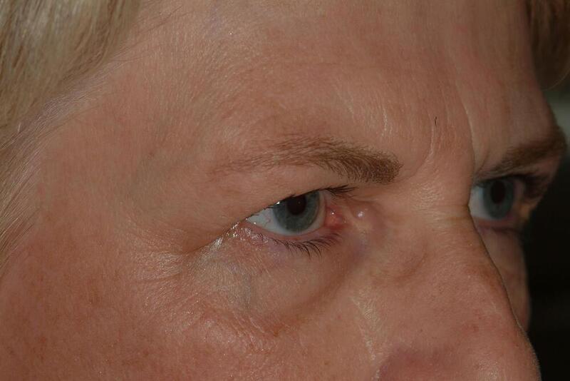 Blepharoplasty Before & After Image