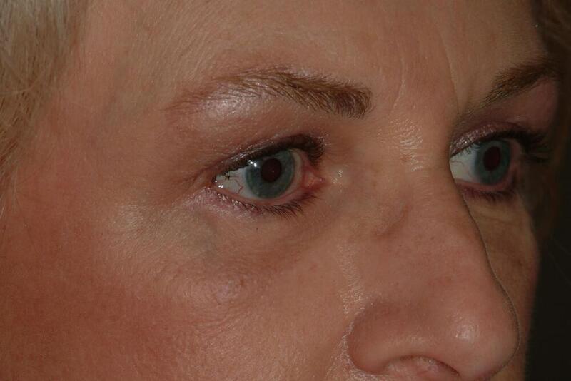 Blepharoplasty Before & After Image