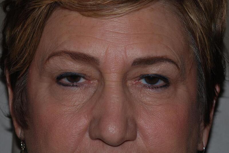 Blepharoplasty Before & After Image