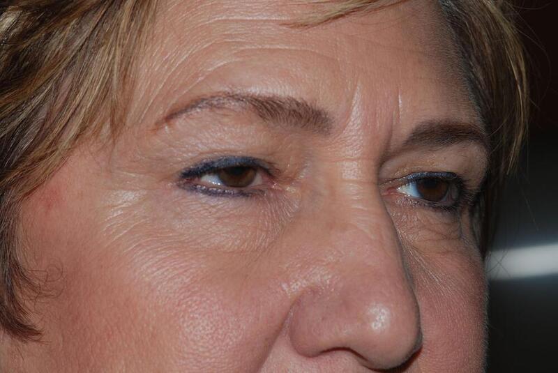 Blepharoplasty Before & After Image