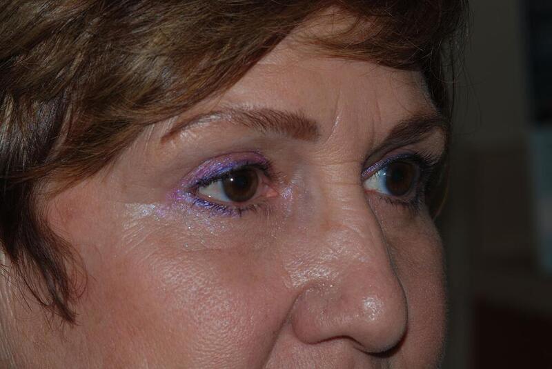 Blepharoplasty Before & After Image