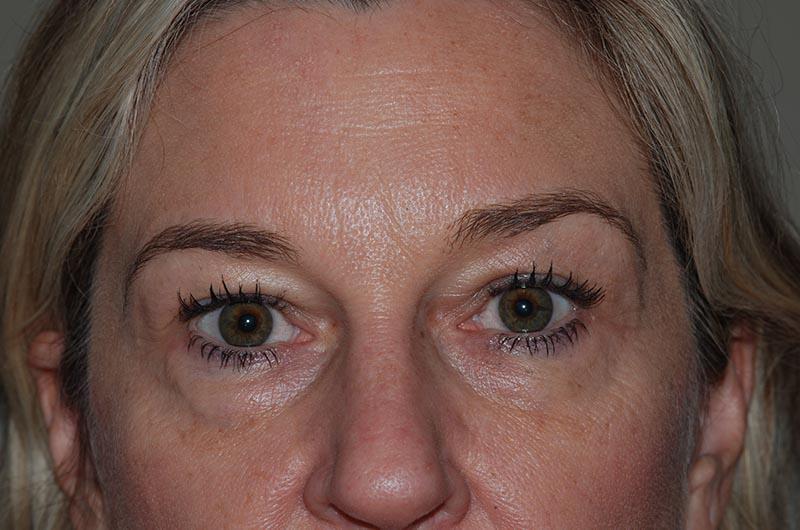 Blepharoplasty Before & After Image