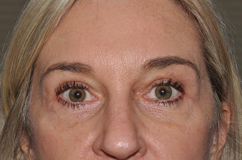 Blepharoplasty Before & After Image