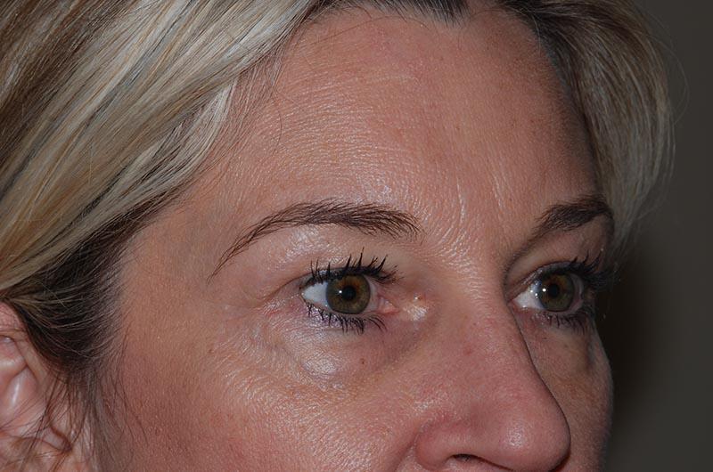 Blepharoplasty Before & After Image