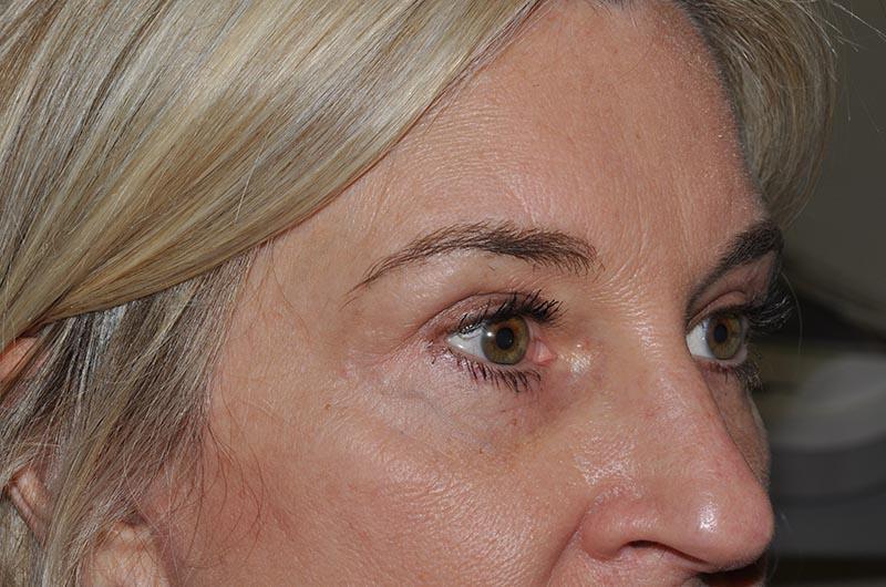 Blepharoplasty Before & After Image