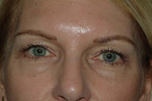 Blepharoplasty Before & After Image