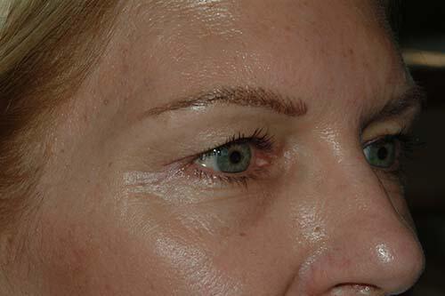 Blepharoplasty Before & After Image