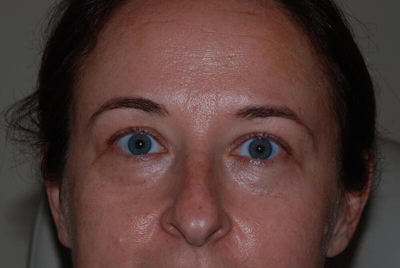 Blepharoplasty Before & After Image