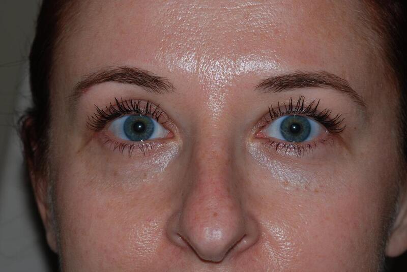 Blepharoplasty Before & After Image