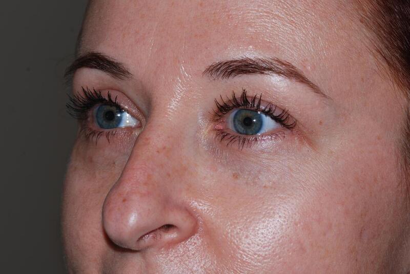 Blepharoplasty Before & After Image