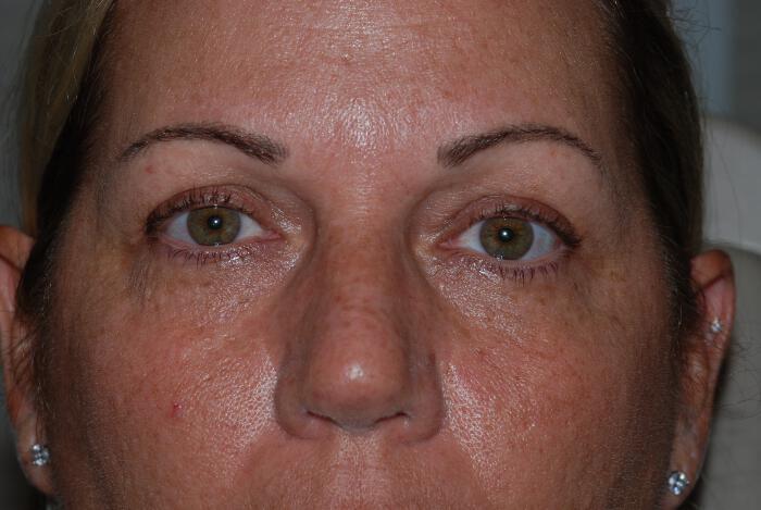 Blepharoplasty Before & After Image