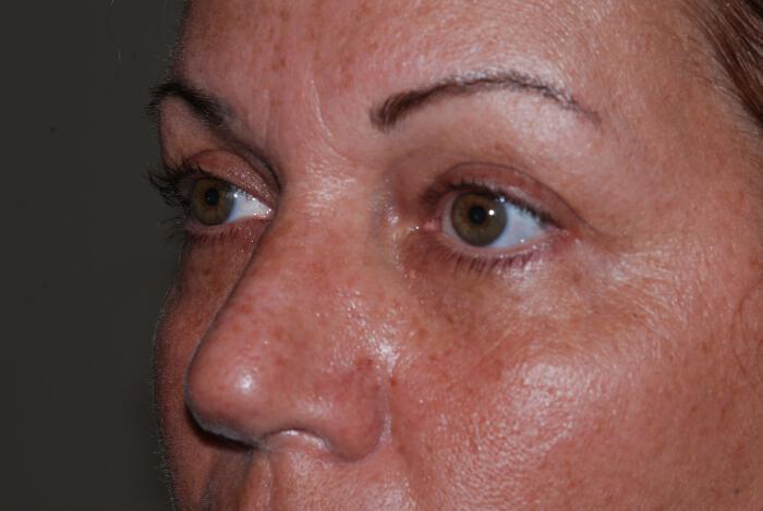 Blepharoplasty Before & After Image