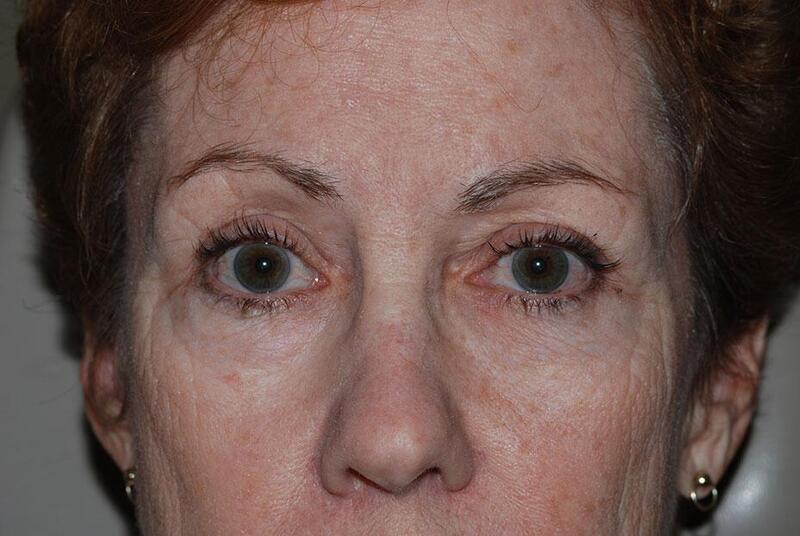 Blepharoplasty Before & After Image