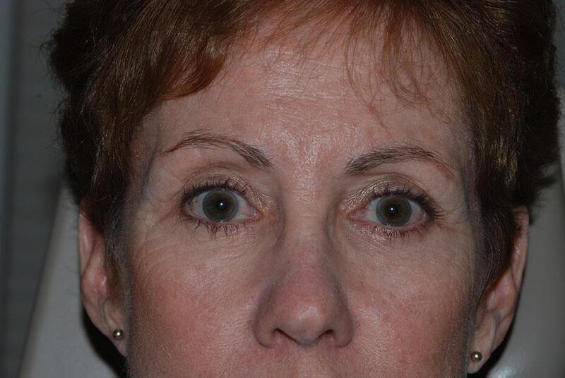 Blepharoplasty Before & After Image