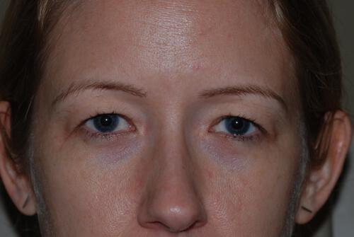 Blepharoplasty Before & After Image