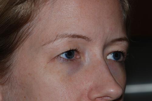 Blepharoplasty Before & After Image